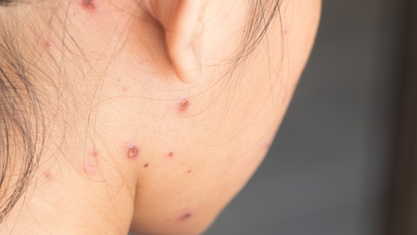 Uşaqlar arasında suçiçəyi yayılıb