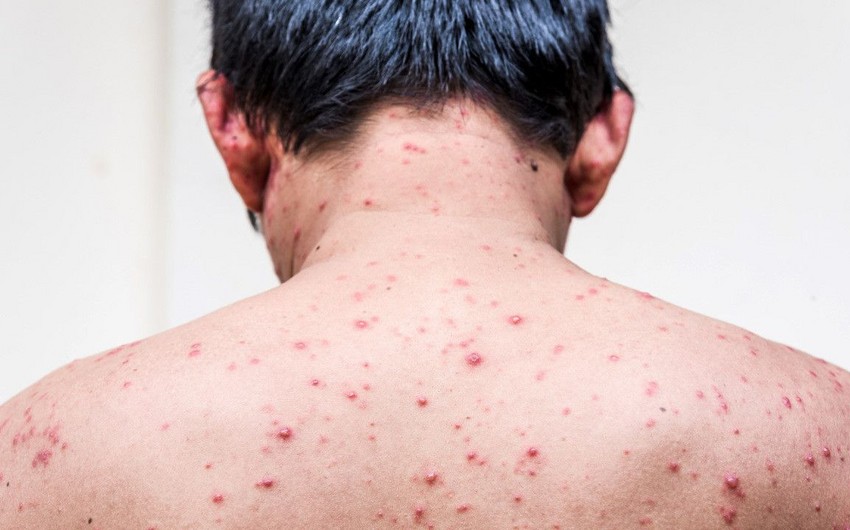 Azərbaycanda suçiçəyinə yoluxma sayı artıb - RƏSMİ