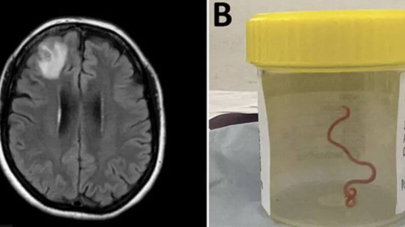 Tibbdə ilk: Avstraliyada qadının beynindən canlı qurd çıxarıldı